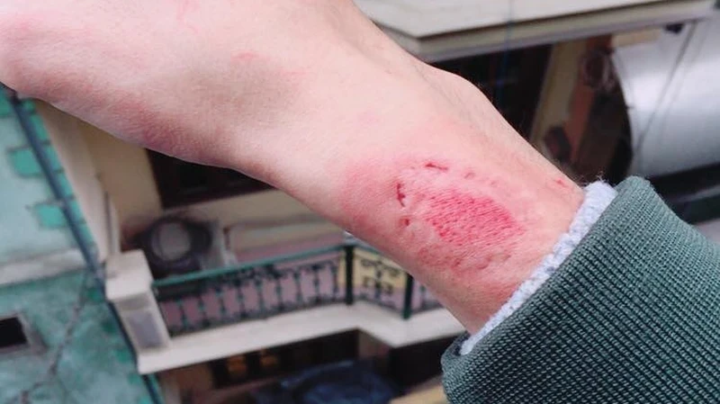 Vết thương sưng đỏ là dấu hiệu bị viêm trùng