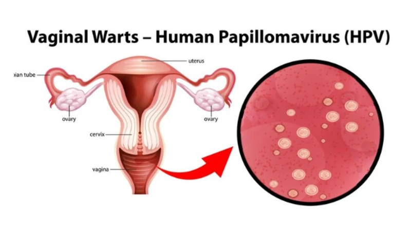 Bị nhiễm HPV type 16 có chữa được không​? 2