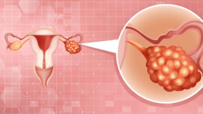Bị nhiễm HPV type 16 có chữa được không​? 3