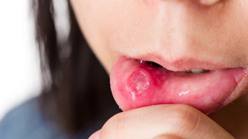 Bị nhiệt miệng nên ăn gì? Chế độ ăn giúp giảm đau, mau lành 1