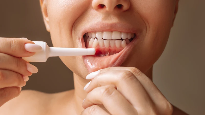 Bị nhiệt miệng ở nướu do đâu và cách xử lý? 1