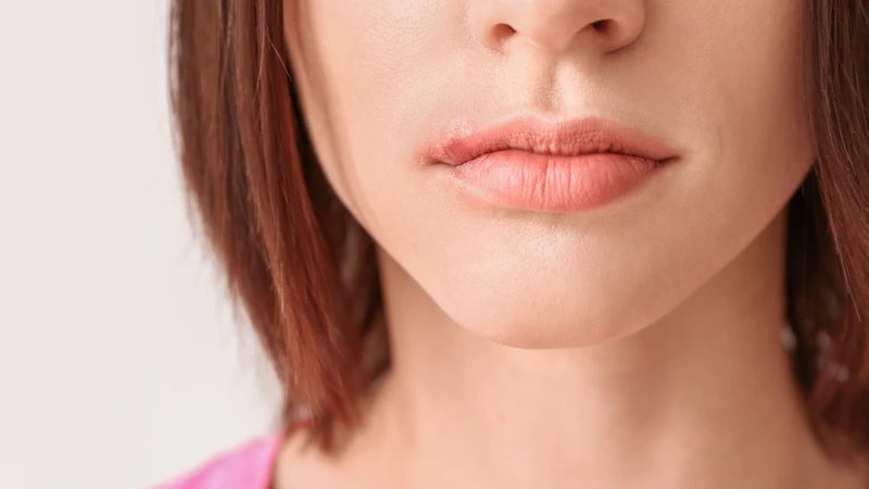 Bị nổi mụn nước ở môi là bệnh gì? 2