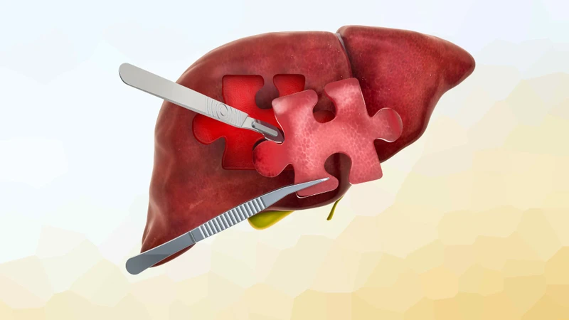Phần lớn polyp túi mật 4mm là lành tính nên thường chưa cần phẫu thuật ngay
