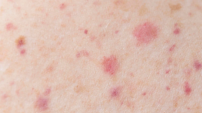 Nguy cơ lây HPV trong đời sống vợ chồng