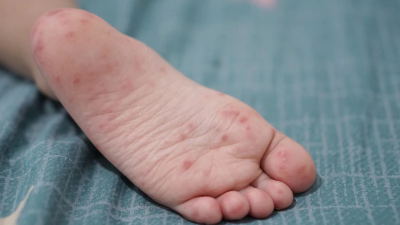 Trẻ có thể mắc tay chân miệng nhiều lần do bệnh liên quan đến nhiều loại enterovirus khác nhau