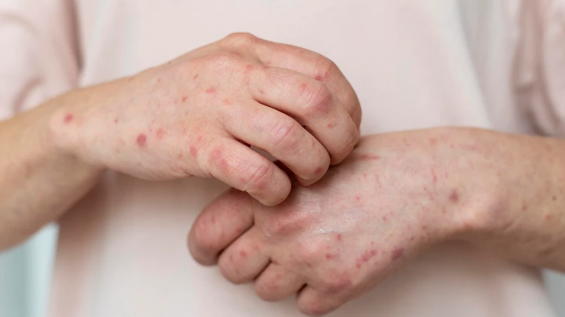 Phần lớn thủy đậu sẽ khỏi trong khoảng 7 đến 10 ngày nếu được chăm sóc đúng cách và không có biến chứng