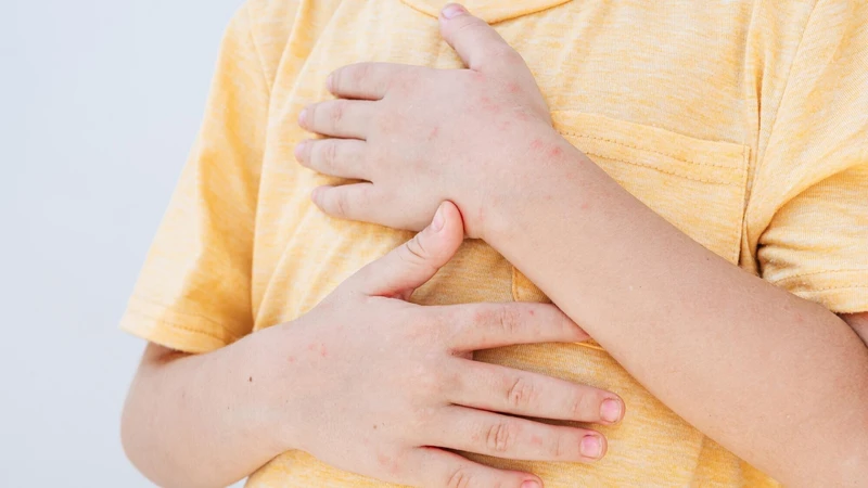 Trẻ cảm thấy đỡ ngứa hơn trong giai đoạn khô vảy ngày 6 đến ngày 10