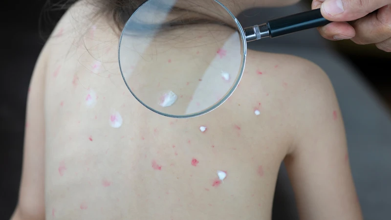 Bị thủy đậu có được gội đầu không? Những điều cần biết để tránh biến chứng 2