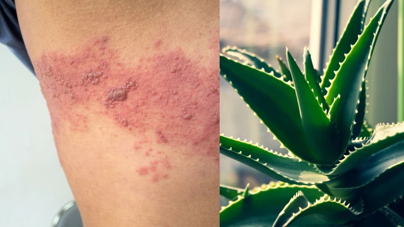 Bị zona bôi nha đam được không? Hướng dẫn đúng cách giúp làm dịu tổn thương da 2