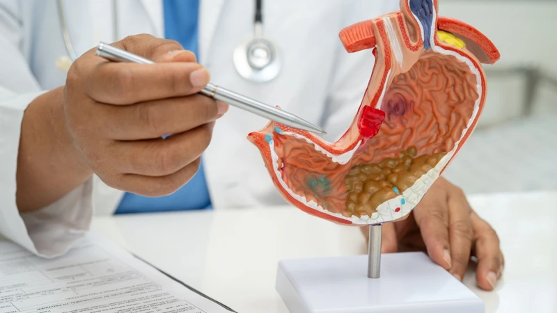 Viêm loét dạ dày mạn tính, đặc biệt ở bệnh nhân nhiễm Helicobacter pylori, làm tăng nguy cơ biến đổi tế bào niêm mạc và tiến triển thành ung thư dạ dày