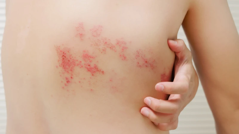 Sau khi khỏi thủy đậu, virus VZV không hoàn toàn bị loại bỏ tiếp tục gây zona thần kinh