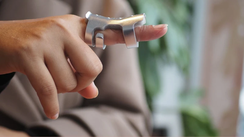 Nẹp và phục hồi chức năng có thể hỗ trợ cải thiện vận động ngón tay