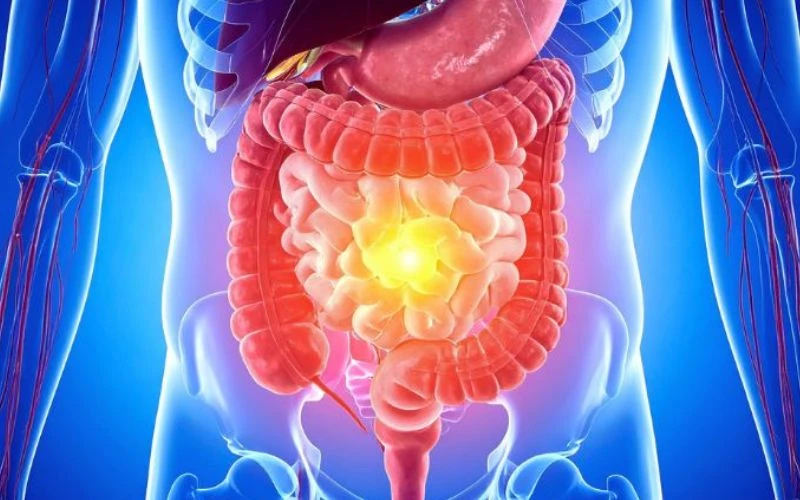 Tiêu chảy sốt ớn lạnh là biểu hiện thường gặp ở người bị rối loạn tiêu hóa, viêm đường ruột