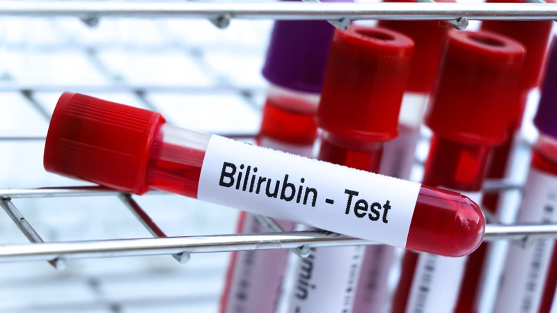 Chỉ số bilirubin toàn phần hữu ích trong chẩn đoán và theo dõi nhiều bệnh lý
