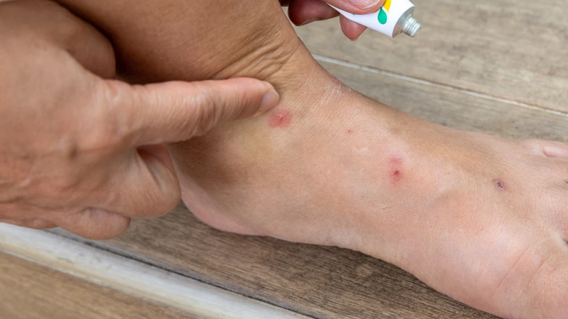 Bọ chét cắn có sao không? Giải thích dễ hiểu