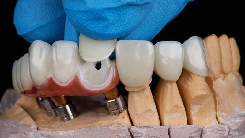Bọc răng sứ có bị hôi miệng không phụ thuộc nhiều vào độ khít giữa mão sứ và nướu