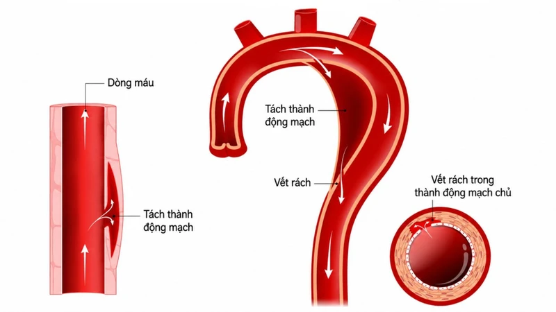 Bóc tách động mạch chủ là tình trạng lớp nội mạc của thành động mạch chủ bị rách, tạo điều kiện để máu chảy vào giữa các lớp của thành mạch