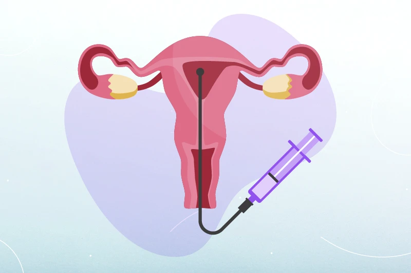 IUI là phương pháp bơm tinh trùng trực tiếp vào buồng tử cung, giúp tăng cơ hội thụ thai