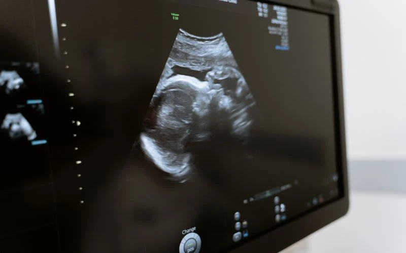 Sau khi thực hiện IUI, việc nghỉ ngơi và theo dõi đóng vai trò quan trọng để đảm bảo hiệu quả và an toàn