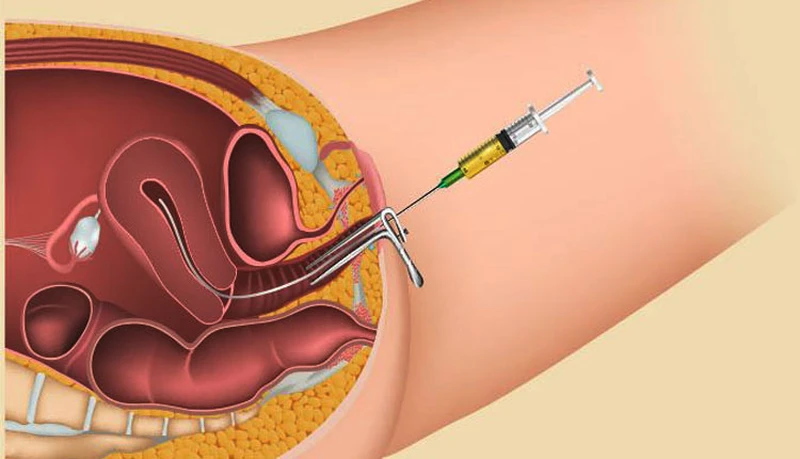 Bơm IUI là gì? Đây là kỹ thuật bơm tinh trùng đã được lọc rửa vào tử cung