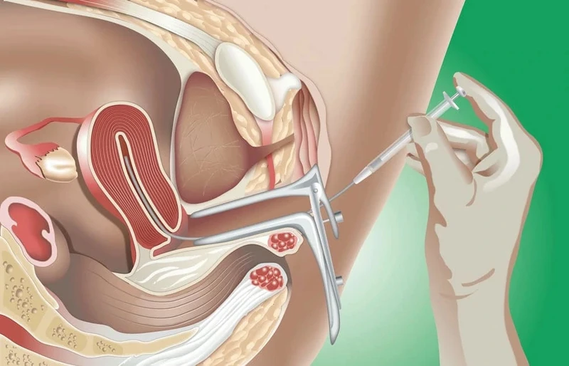IUI là kỹ thuật hỗ trợ sinh sản đưa tinh trùng trực tiếp và tử cung