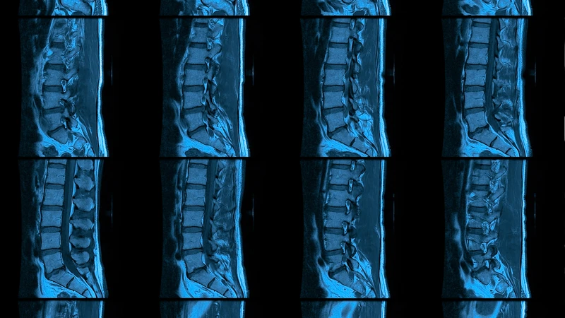 Chụp MRI cột sống giúp bác sĩ đánh giá chính xác tổn thương và lập kế hoạch điều trị