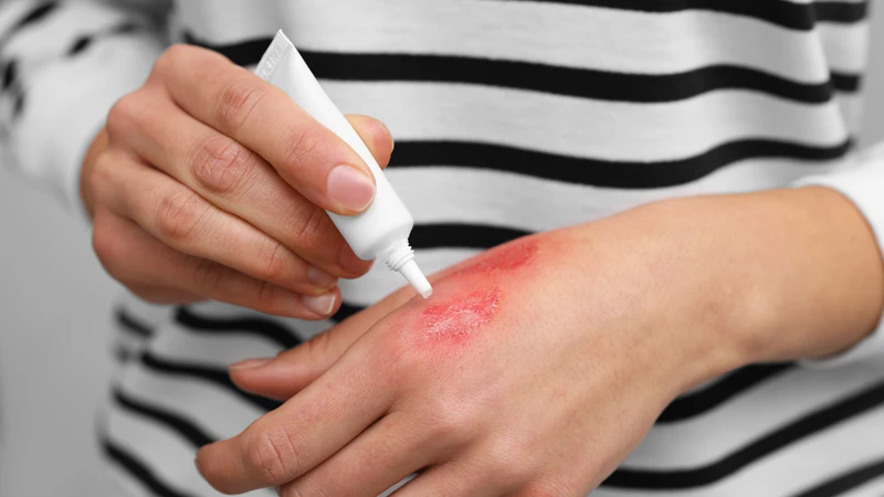 Bỏng bô xe máy có thể để lại sẹo nếu không được xử lý và chăm sóc đúng cách