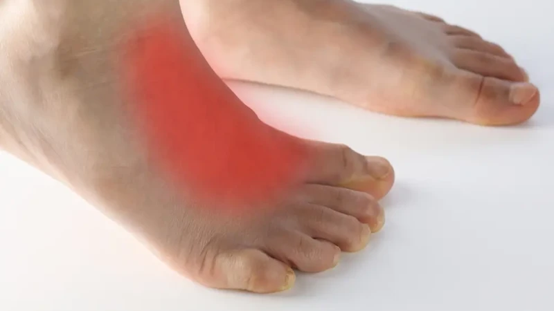 Triệu chứng bong gân mu bàn chân gồm sưng, đau và khó vận động