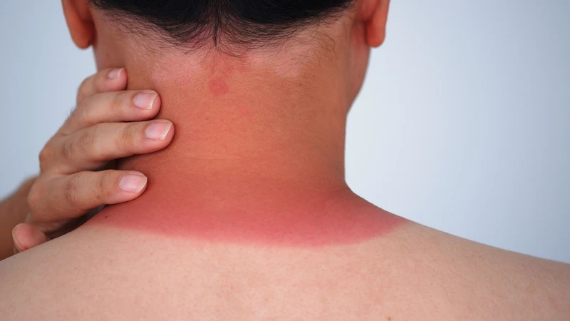 Bỏng nắng gây tổn thương da với biểu hiện đa dạng