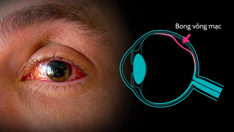 Bong võng mạc có chữa được không là băn khoăn của nhiều người bệnh