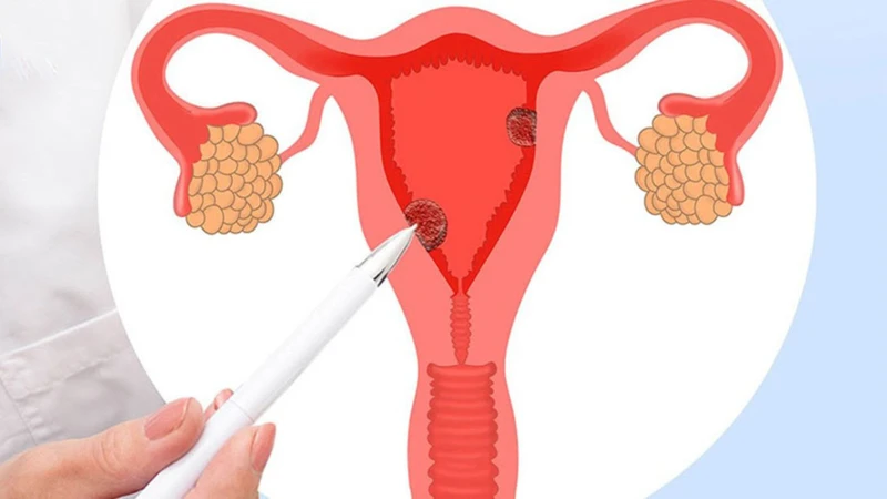 Buồng trứng có nhiều nang nhỏ có thai được không? Lời giải đáp từ chuyên gia y tế 1