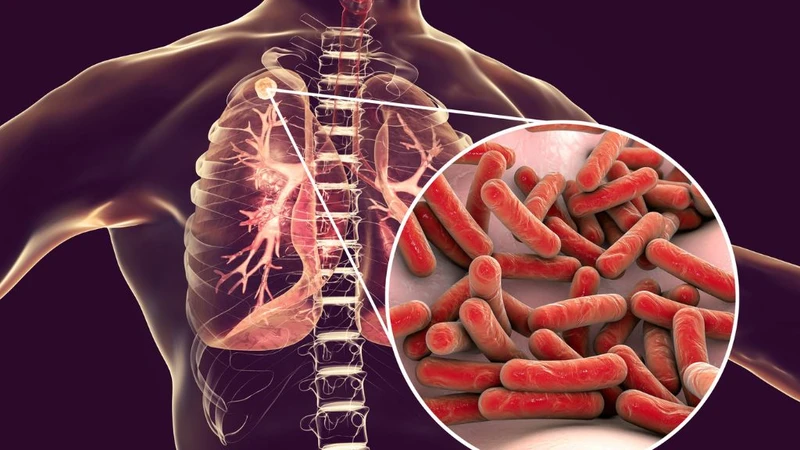 Các bệnh có triệu chứng ho có đờm mà bạn nên biết 3