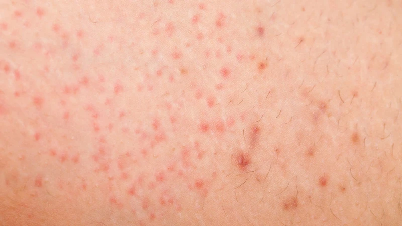 Các bệnh lý gây mụn thịt ở vùng kín là gì và mụn thịt có gây ảnh hưởng ra sao? 1