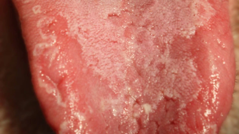 Nguyên nhân gây nên các bệnh về lưỡi có thể do vi khuẩn, virus hoặc nấm Candida