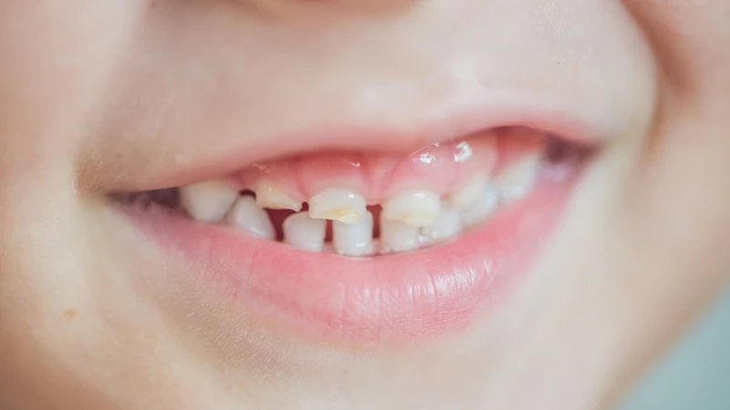 Các cách xử lý khi răng sữa của trẻ bị mòn ba mẹ cần biết 1