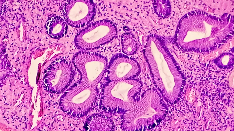 Một trong các dạng polyp biểu mô dạ dày thường gặp là polyp tuyến đáy vị