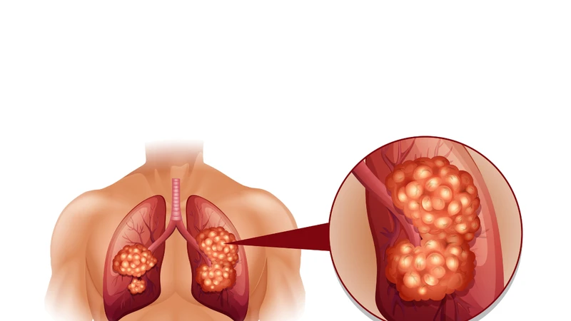 Các dấu ấn ung thư phổi thường gặp 4