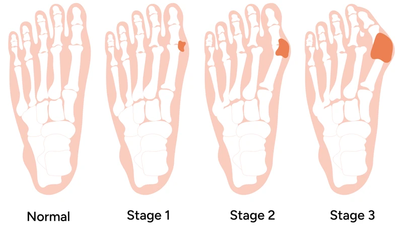 Minh họa hình ảnh bệnh gout theo từng giai đoạn