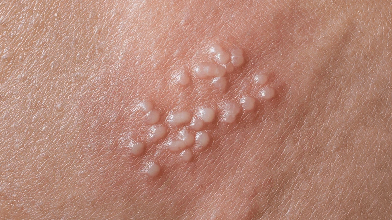 Các loại mụn ở vùng kín thường gặp và cách điều trị 1