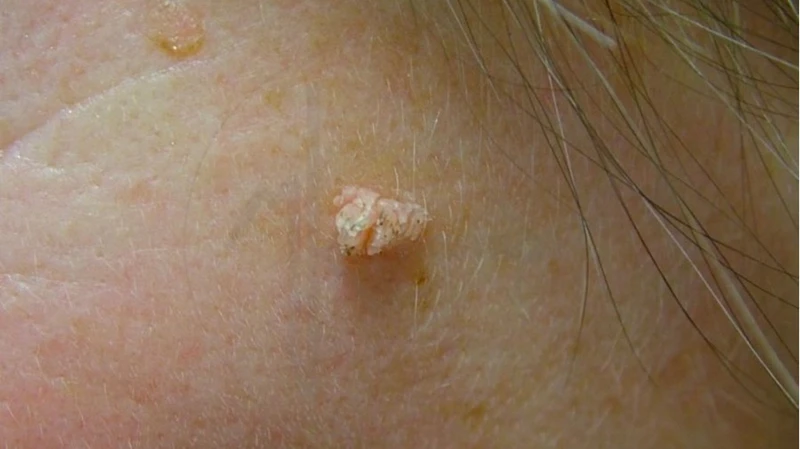 Các loại mụn ở vùng kín thường gặp và cách điều trị 3