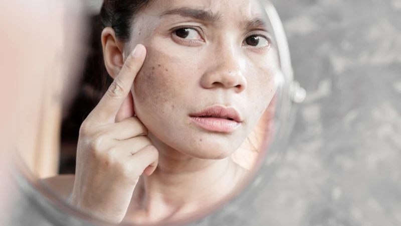 Nhiều yếu tố môi trường và lối sống có thể làm nám xuất hiện hoặc lan rộng nhanh hơn