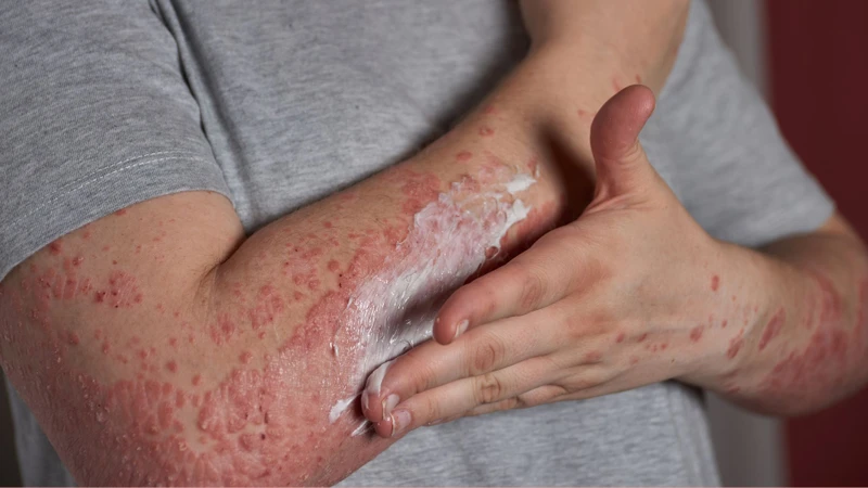 Tổn thương da có thể nặng hơn khi bôi thuốc chứa neomycin