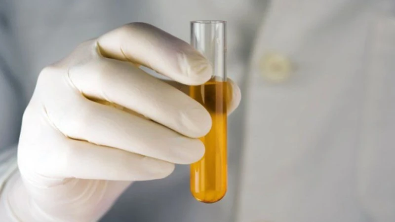 Glucose dương tính có thể gặp ở người tiểu đường, thai kỳ hoặc sau khi ăn ngọt nhiều