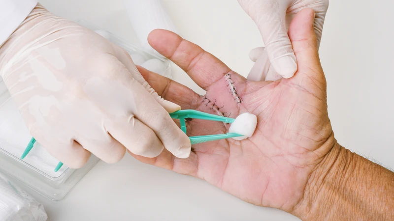 Cách cầm máu khi bị đứt tay​ nhanh chóng và an toàn? 5