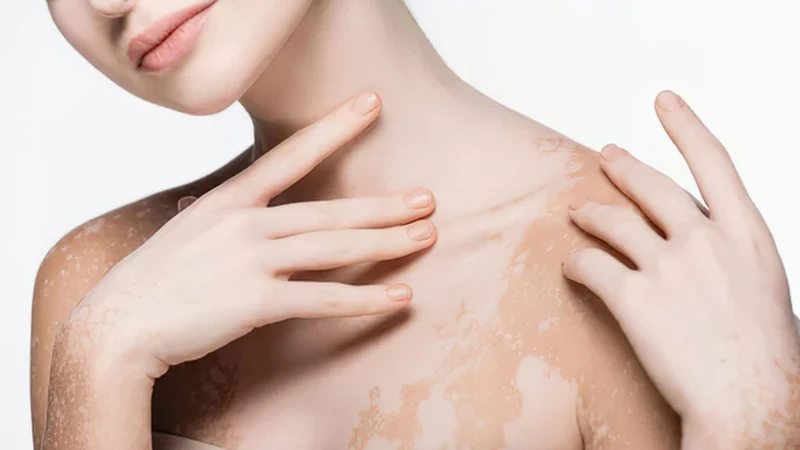 Thuốc bôi tại chỗ là một cách chữa bệnh bạch biến