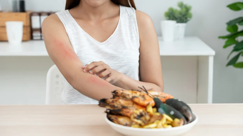 Dị ứng hải sản khiến da ngứa nổi mẩn, do hệ miễn dịch phản ứng quá mức