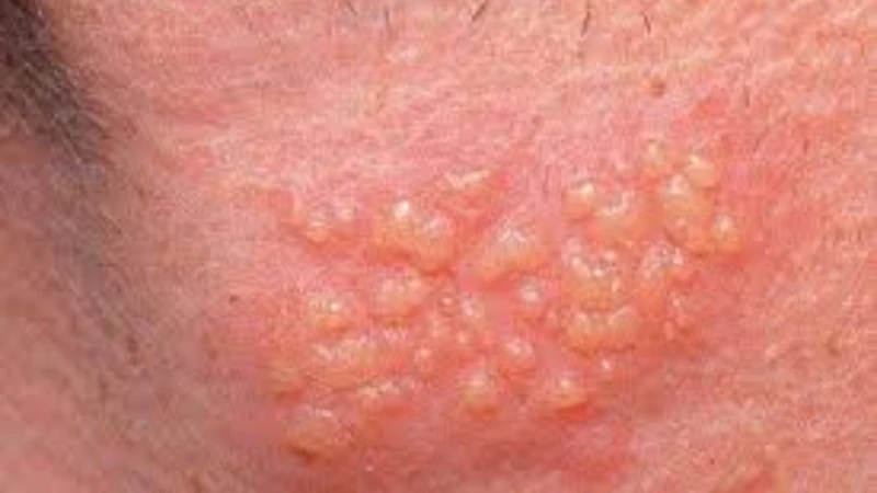 Mụn ở&nbsp;bao quy đầu có thể xuất hiện do nhiều nguyên nhân khác nhau