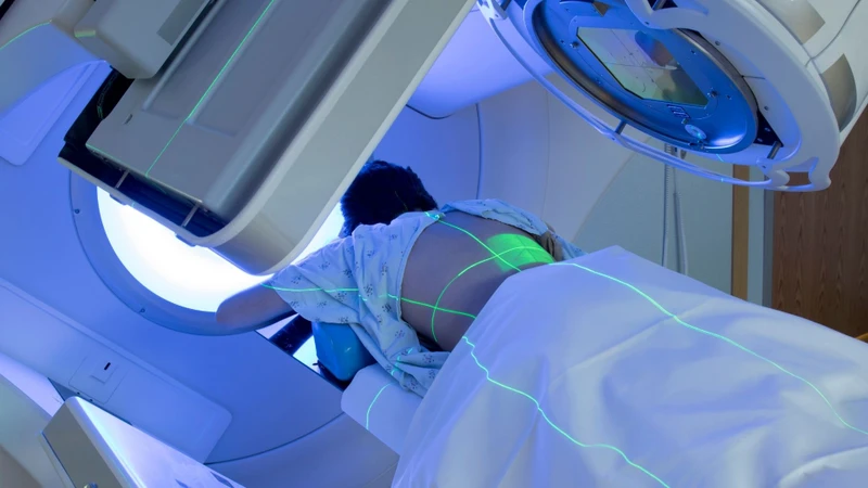Xạ trị sử dụng tia bức xạ năng lượng cao để phá hủy DNA của tế bào ung thư