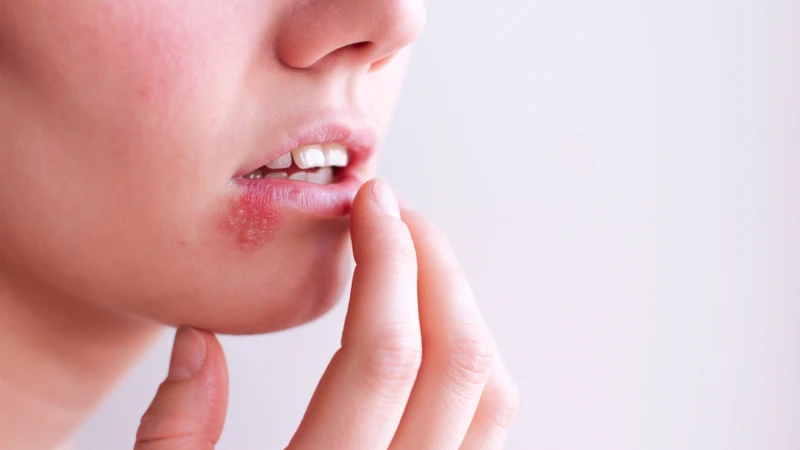Acyclovir dạng kem chủ yếu dùng điều trị nhiễm herpes simplex như mụn rộp môi và sinh dục