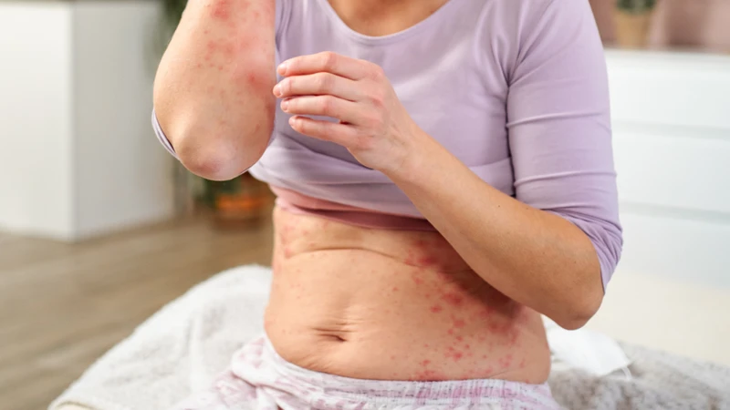 Acyclovir bôi có thể gây nóng rát, ngứa, đỏ hoặc khô da tại vị trí sử dụng